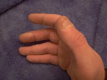 my blisters