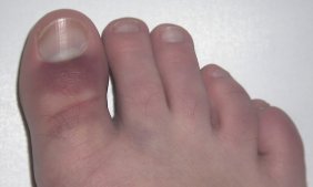 My poor toe!